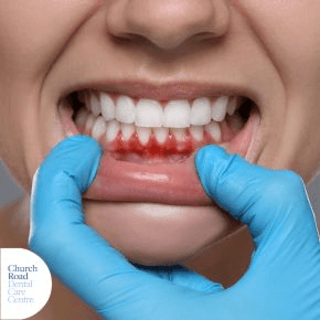A gloved hand pulling down a close up of lips to reveal inflamed gums and teeth